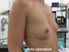 plastic-surgery-breast-augmentation 